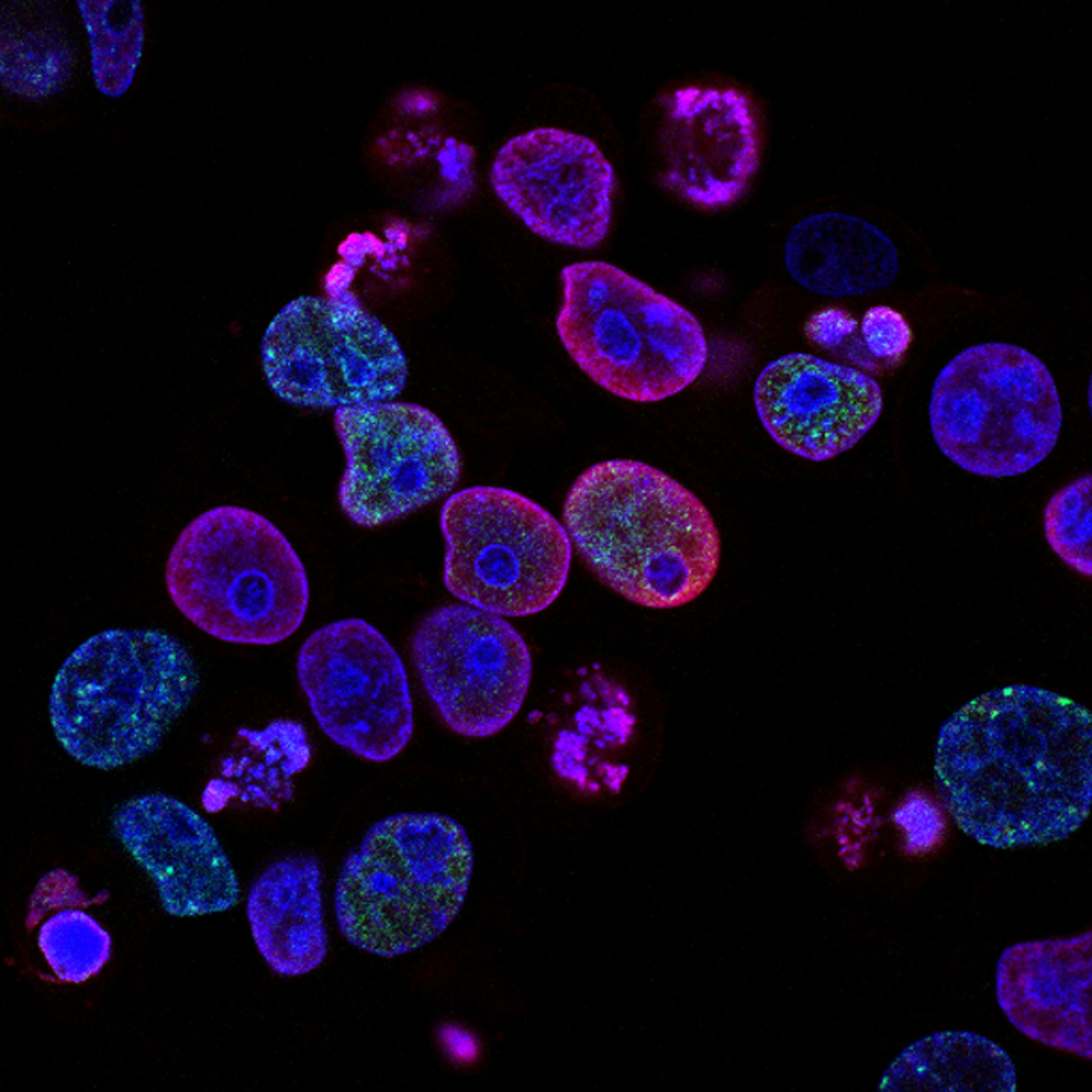 \tHuman colorectal cancer cells treated with a topoisomerase inhibitor and an inhibitor of the protein kinase ATR (ataxia telangiectasia and Rad3 related), a drug combination under study as a cancer therapy. Cell nuclei are stained blue; the chromosomal protein histone gamma-H2AX marks DNA damage in red and foci of DNA replication in green.  Created by Yves Pommier, Rozenn Josse, 2014